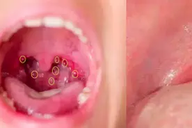 【呱呱教·58】宝宝得了疱疹性咽峡炎，别着急！图片