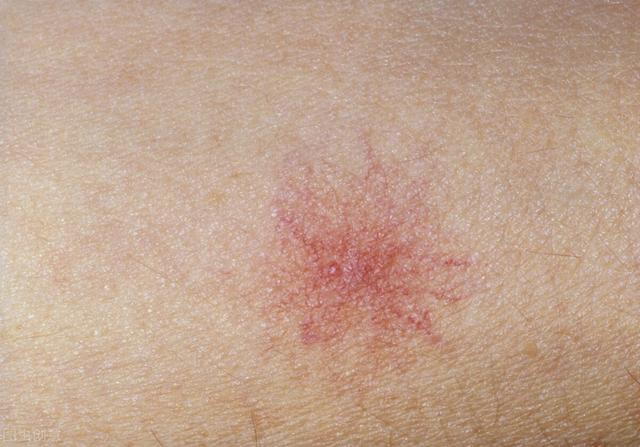 胸口长红点点鸡皮肤一样