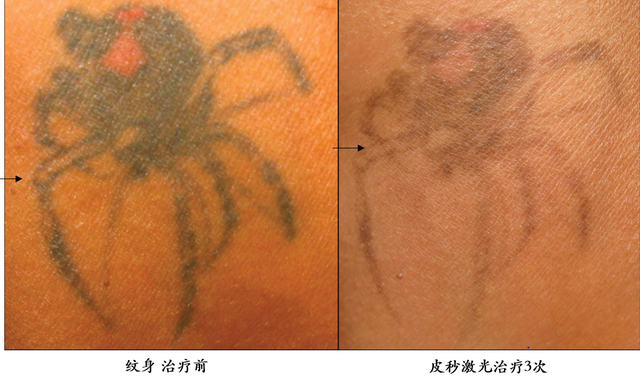 激光点脂溢角化会留下疤痕吗