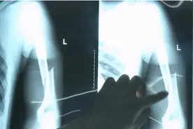 掰手腕，手臂断了！抖个腿，脚折了！现在年轻人骨头不如老人硬？图片