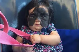 萌宝脸上胎记像蝙蝠侠，妈妈晒女儿照片却被“网暴”：她是怪物图片