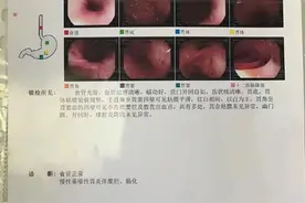 叶酸+摩罗丹，治疗萎缩性胃炎伴肠化图片