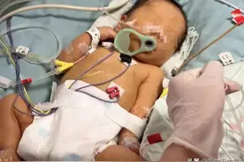 惊险！福州一宝宝刚出生便全身换血！这种病和血型有关，孕期注意排查图片
