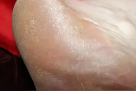 脚上干裂居然是真菌惹的祸图片