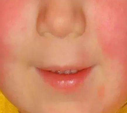 胸部长了很多鸡皮疙瘩