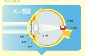 激光近视手术已被ICL人工晶体植入技术广泛取代图片