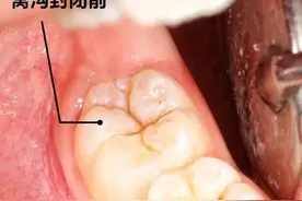 90%的孩子都有蛀牙：别再让孩子补牙，这个方法更有效图片