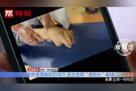 年轻女子患怪病，左脚变形像“鸡爪”，走不了路，还流口水图片