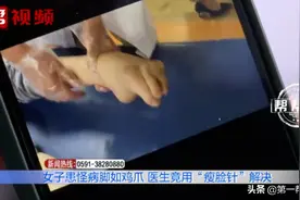 年轻女子患怪病，左脚变形像“鸡爪”，走不了路，还流口水图片