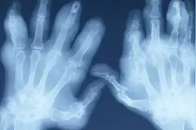 痛风一般先从哪里开始痛？这些部位开始痛就得重视了视频封面