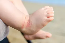 儿童湿疹，做好这一件事，湿疹不再来了图片