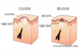 痘痘科普第二篇（闭口粉刺，开口粉刺）图片