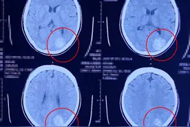 胶质瘤真的没办法治疗吗？高级别胶质瘤还有必要做手术吗？图片