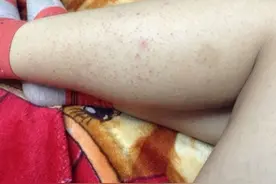 双侧上臂、脸颊的小疙瘩是怎么回事？鸡皮病？图片