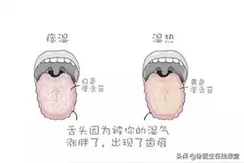 舌头边缘有牙齿印到底是怎么回事？医生教你怎么搞定“齿痕舌”图片