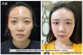 28岁江苏美女，牙齿矫正后却意外脸型变丑，凹陷脸如何能再变美？图片