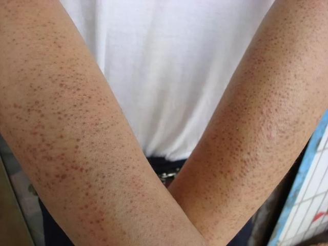 屁股上的小疙瘩是毛周角化吗