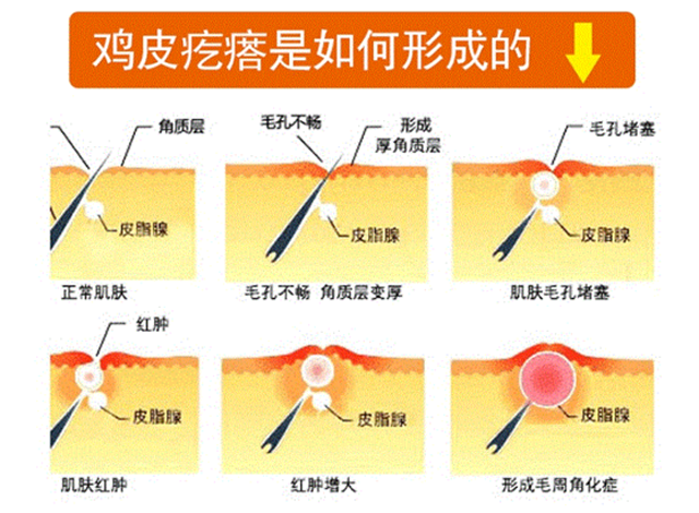 鸡皮疙瘩要涂什么果酸