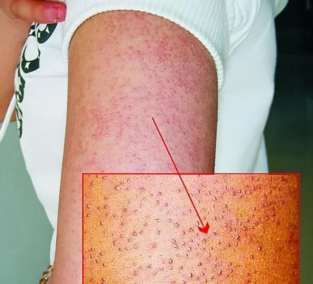 腿上又有毛又有毛囊角化症怎么治疗