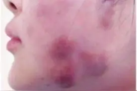 揭秘：溶脂针导致皮肤大面积溃烂，违禁项目你还敢乱打吗？图片