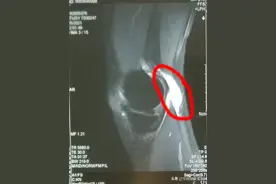 腿弯处鼓起一个肿块，涨涨的，是肿瘤吗？图片