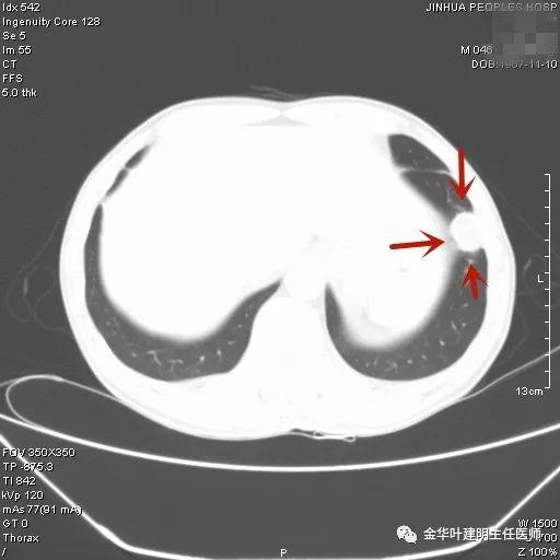 叶建明谈结节：检查发现肺实性结节怎么办？个人版实用指南