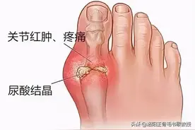 高尿酸，最怕“痛风性关节炎”，这个煲汤诀窍，痛风患者要谨记图片