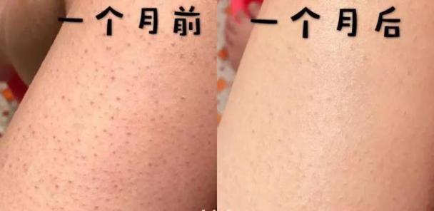 去粉刺毛囊炎痤疮鸡皮身体乳