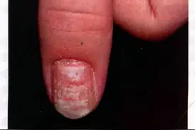 原来指甲有斑点、竖纹、变厚，竟真的预示这些病图片