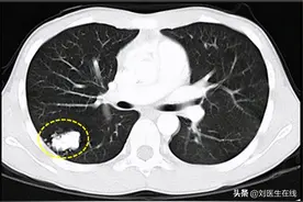 肺部结节分为实性、部分实性和纯磨玻璃结节，哪种更可能是肺癌图片