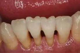 牙齿松动了，拔还是不拔？看看良心老牙医的建议图片