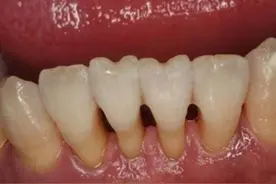 牙齿松动了，拔还是不拔？看看良心老牙医的建议图片