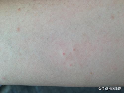 梅毒到底能不能治愈？看医生怎么说！