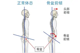 骨盆前倾详解及改善方法图片