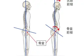 骨盆前倾详解及改善方法图片