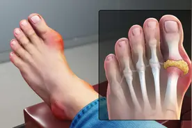 尿酸都超标，有人被痛风折磨，有人却毫无症状，为啥？医生告诉您图片