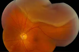 认识视网膜脱离图片