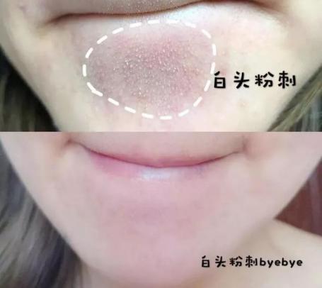 去粉刺毛囊炎痤疮鸡皮身体乳