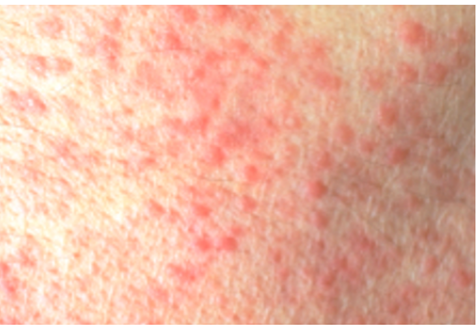 角化过度角化不全炎症