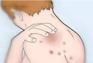 银屑病洗澡后擦身体乳