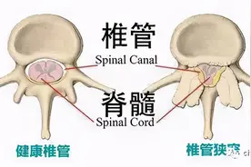 腰椎管狭窄常见问题解答图片