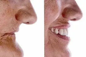 牙齿有问题，拔掉就完事？医生：不到万不得已，不会轻易拔牙图片