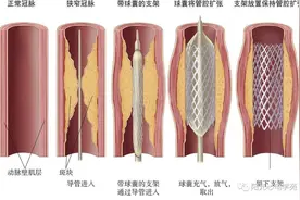 支架，可能是“放支架”过程中最没技术的耗材，大幅降价是必然图片