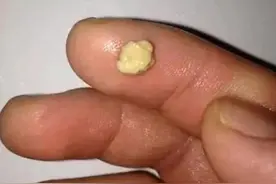 咽部有异物感，用力一咳，咳出很臭的“小石头”？经历过的看过来图片