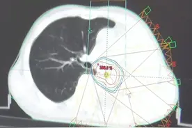 左肺被肿瘤堵死缩成一团，放疗后吐出一块“鱼肉”，肺瞬间充满图片