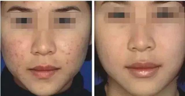 美肌冻干粉有什么作用 美肌冻干粉有什么作用和功效