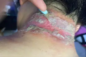 关灯玩手机，女子差点毁容！这“毒虫”深圳也有，千万别上手拍图片