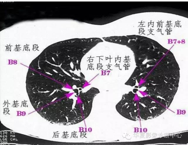 精华,胸部ct读片 解剖