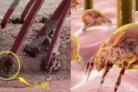 头发上抠下来的白色脏东西，究竟是什么？显微镜下看到它的真面目图片
