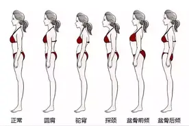 探头驼背？是上交叉综合征啦，带你正确认识不良体态图片
